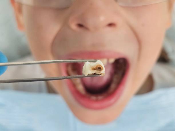 Best Emergency Dentist for Lost Fillings or Crowns in Hamilton, IN